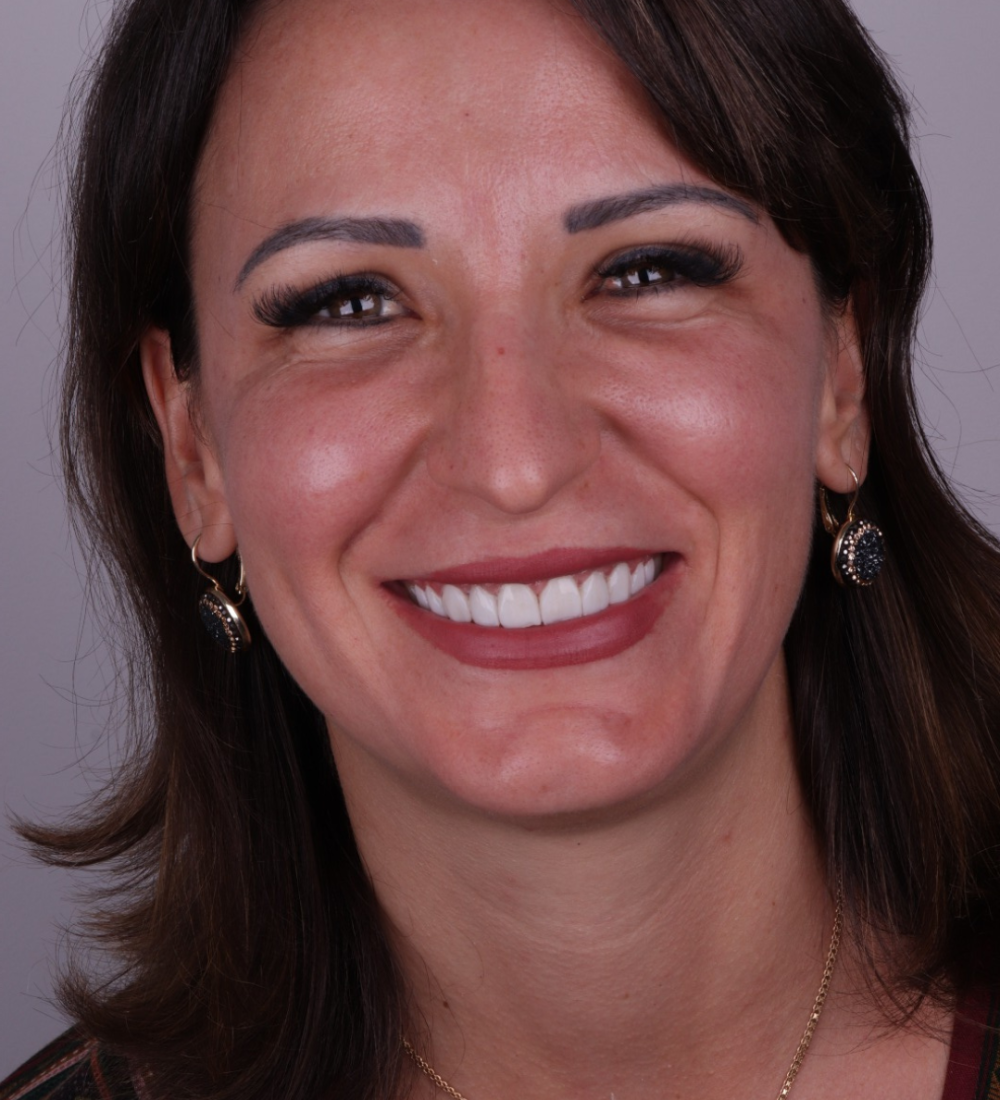 Cliente mulher satisfeita com o resultado das facetas de resina realizadas na clínica Dents Primer, em Catanduva, SP.