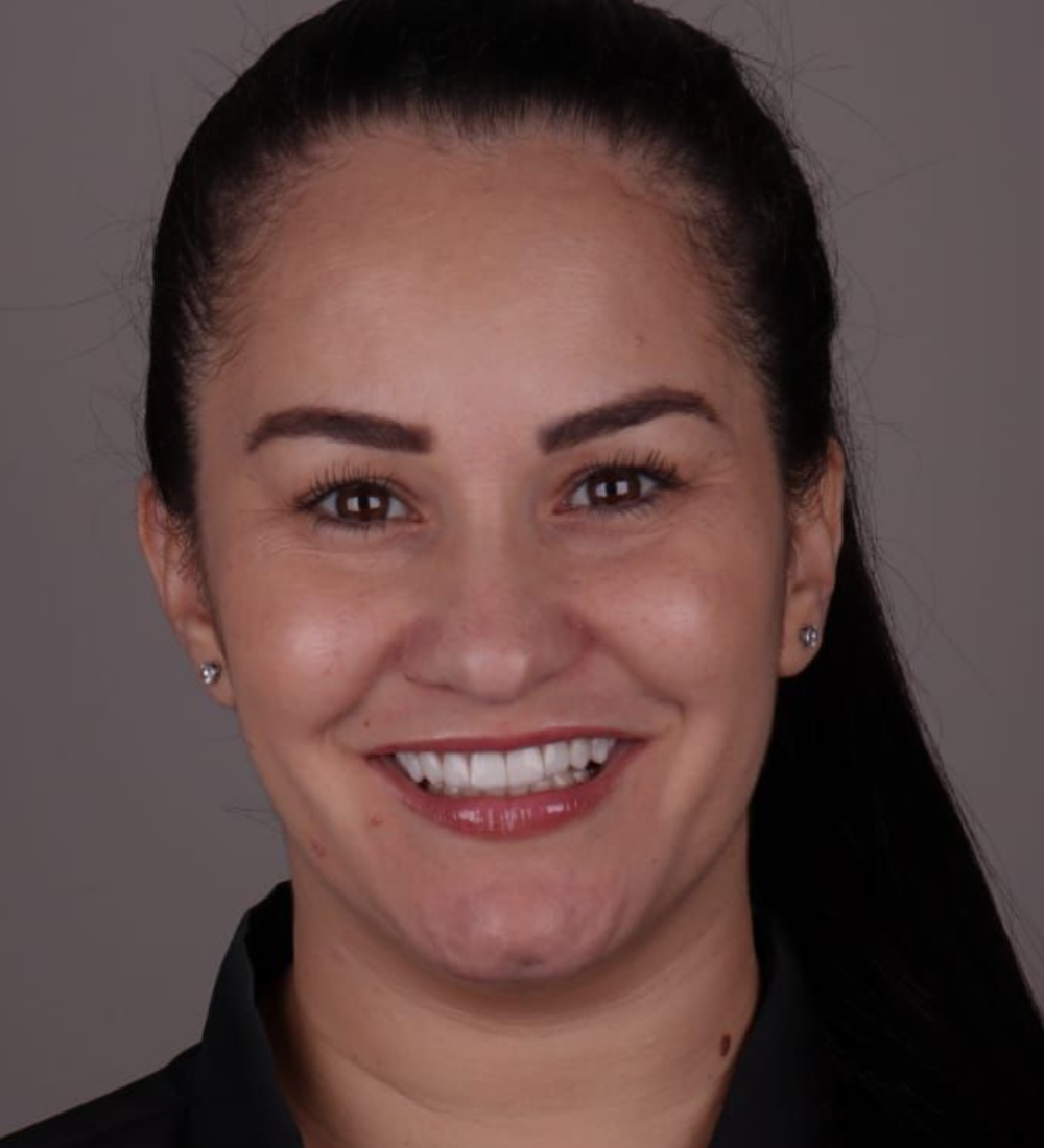 Cliente feliz com o atendimento da Dra. Renata Terra e o resultado das facetas de resina na Dents Primer, em Catanduva, SP.